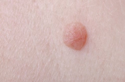 ¡Verrugas! ¿Tengo que ir al dermatólogo?